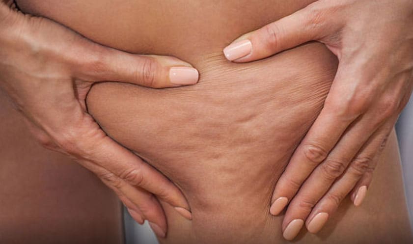 Combattere la cellulite: quando serve l’intervento di un esperto.